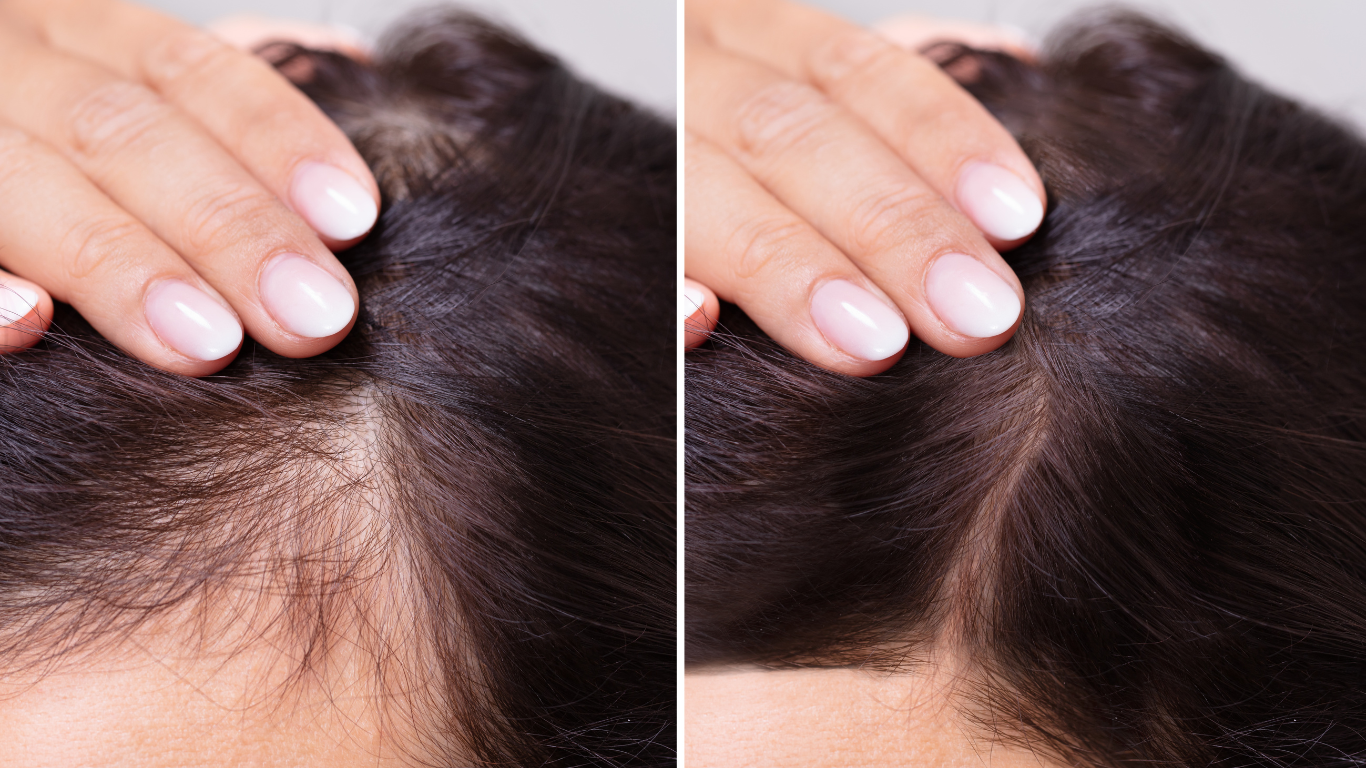 Causes of Hair Loss and the Current Treatments
